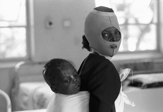 Uganda, 103-014-32 All'interno dell'ospedale, una donna indossa una guaina per il volto e porta sulla schiena un bambino con cicatrici da ustione sul volto, 2008 Ospedale Mulago, Kampala (Uganda)