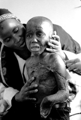 Uganda, 103-014-10
Un bambino con grandi cicatrici da ustione viene esaminato con lo stetoscopio mentre una donna lo supporta , 2008
Ospedale Mulago, Kampala (Uganda)