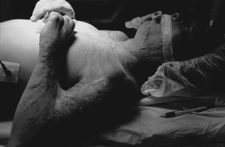 Cina, 102-034-09
Uomo con cicatrici e braccio deformato sottoposto a intervento, 2007
Ospedale Civile, Siyang (Cina)