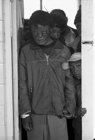 Tibet, 102-025-08 Bambino con cicatrici da ustione sul volto e sulle mani, davanti ad altre persone in una stanza di ospedale, 2004 Shigatse (Tibet)