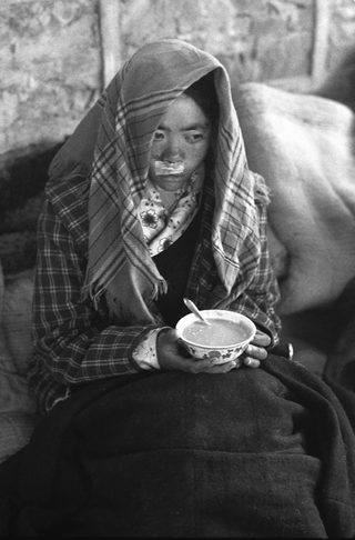 Tibet, 102-020-15
Una donna operata al labbro leporino siede con una ciotola di zuppa tra le mani, 2004
Shigatse (Tibet)