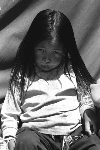 Tibet, 102-018-10 Una bambina operata al labbro leporino, 2004 Shigatse (Tibet)