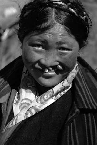 Tibet, 102-010-20 Ritratto di donna con malformazione alla bocca, 2004 Shigatse (Tibet)