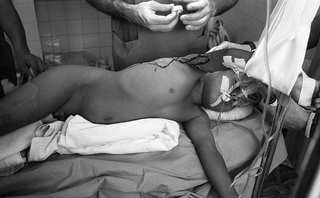 Bolivia, 104-006-14
Bambino sottoposto a un'operazione, 2010
Ospedale Municipale, Camiri (Bolivia)