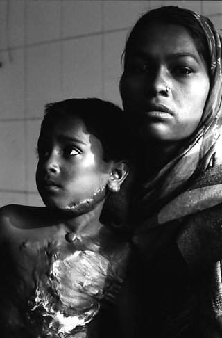 Bangladesh, 103-029-05
Bambina con ustioni in braccio a una donna, 2009
Dacca (Bangladesh)